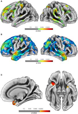 Exploring Signatures of Neurodegeneration in Early-Onset Older-Age Bipolar Disorder and Behavioral Variant Frontotemporal Dementia